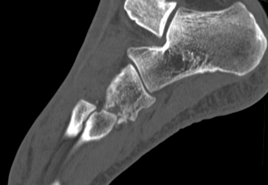 Cuboid Fracture Lis Franc